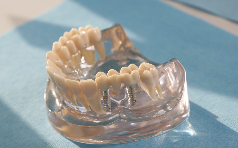 Zahn­implantate